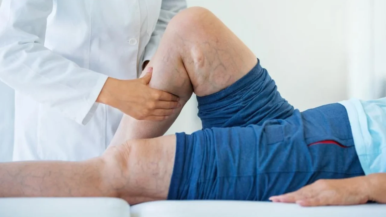 CVI Symptoms 10 Signs of Chronic Venous Insufficiency