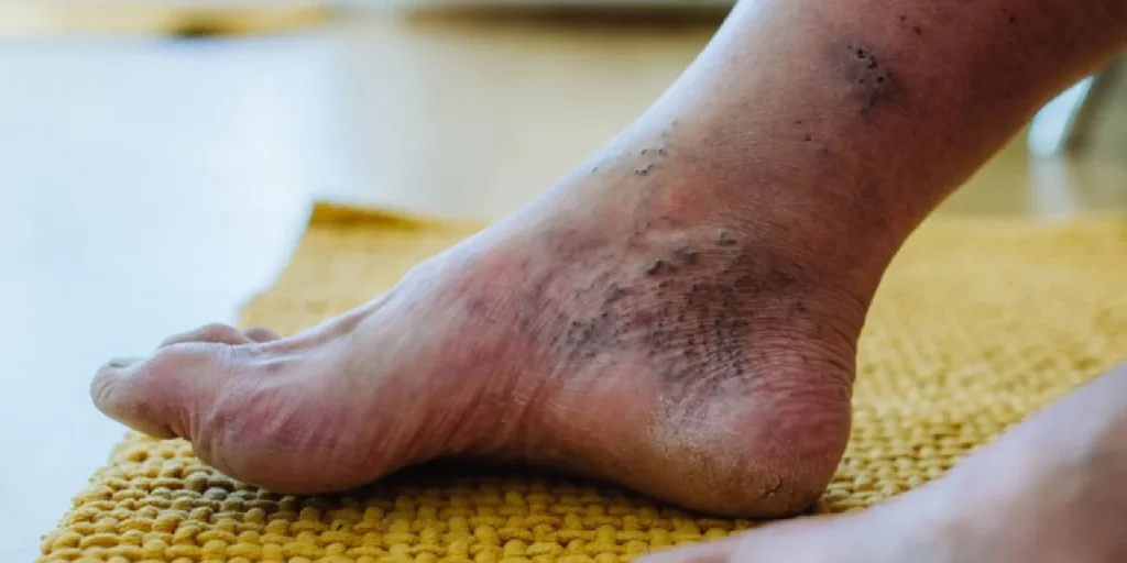 Diabetes and PAD (Peripheral Arterial Disease)